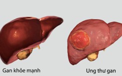Dấu hiệu nào cảnh báo sớm ung thư gan?
