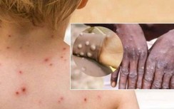 Xuất hiện ca đậu mùa khỉ đầu tiên ở VN: Có đáng lo ngại?