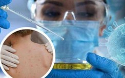 TP.HCM công bố ca mắc đậu mùa khỉ đầu tiên tại Việt Nam