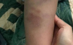 Đà Nẵng: Đang xác minh vụ học sinh lớp 1 bầm tím tay, chân sau tan trường