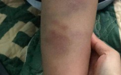 Học sinh lớp 1 Đà Nẵng bầm tay, chân sau tan trường do đánh nhau với bạn