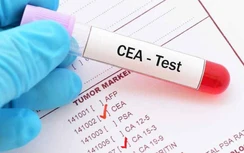 Rước âu lo vì dùng xét nghiệm máu tầm soát ung thư