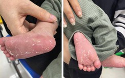 Cha mẹ ngỡ ngàng khi trẻ mắc bệnh người lớn