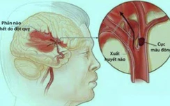 Những dấu hiệu nhận biết sớm đột quỵ