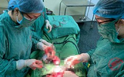 Hi hữu sản phụ mang thai đôi ở 2 tử cung khác nhau