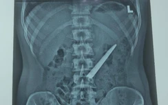 Nam thanh niên ở Bạc Liêu nuốt lưỡi dao Thái Lan vào bụng, không thủng ruột