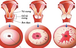 Khi nào cần xét nghiệm ung thư cổ tử cung?