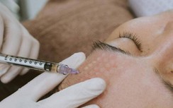 Nổi mụn li ti, u hạt sau tiêm meso vi điểm căng bóng da mặt