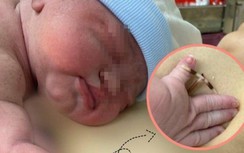 Bé gái ở Vĩnh Long chào đời cùng vòng tránh thai của mẹ