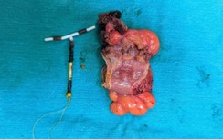 Một phụ nữ thủng đại tràng, tử cung vì vòng tránh thai đi lạc