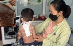 Tưởng vết bớt thông thường, không ngờ trẻ mắc bệnh hiếm gặp