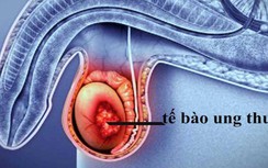 Dấu hiệu nào cảnh báo ung thư tinh hoàn?