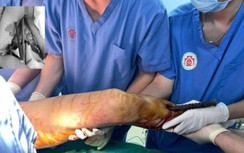 Rơi từ tầng 5, nam thanh niên bị 3 cọc sắt bê tông đâm xuyên người