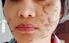 Youtuber, Tiktoker vây nhà người chồng bạo hành vợ mang thai ở Hải Dương