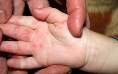 Đã có trẻ tử vong vì tay chân miệng, cha mẹ đặc biệt lưu ý 3 dấu hiệu này