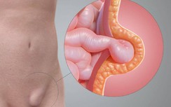 Cách nào phát hiện thoát vị bẹn ở trẻ?