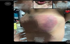 Xác minh vụ người dạy trẻ ở Khánh Hòa bị tố đánh bé trai chảy máu miệng