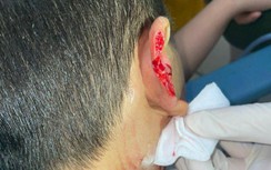 Nhiều trẻ nhỏ nát mặt, đứt vành tai vì bị chó tấn công