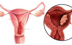 Dấu hiệu nào phát hiện ung thư niêm mạc tử cung?