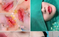 Tiêm filler ở cơ sở chui, một phụ nữ bị mờ mắt phải đi cấp cứu