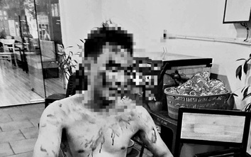 Hải Dương: Nam thanh niên bị đánh nhập viện khi đang ngồi trong phòng trà 
