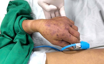 Cụ ông nguy kịch vì nhiễm liên cầu lợn sau 3 ngày ăn tiết canh