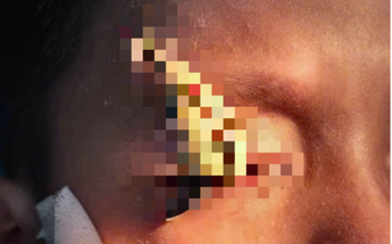 Xem câu nhái, nam sinh suýt mù vì lưỡi câu văng vào mắt