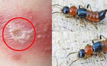 Bác sĩ cảnh báo không chủ quan với tổn thương do kiến ba khoang gây ra