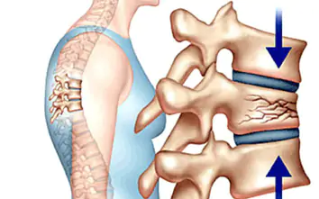 Biến chứng xẹp gãy đốt sống vì chủ quan với loãng xương